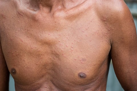 Climate change impacting skin health, disproportionately burdening lower-income countries