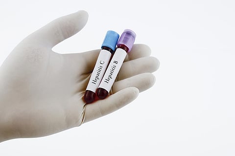 Hepatitis is the second leading infectious cause of death globally after tuberculosis. Photo for representation: iStock