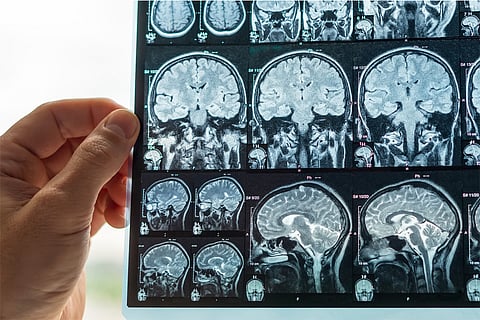 मस्तिष्क के एमआरआई का विश्लेषण करते डॉक्टर; प्रतीकात्मक तस्वीर: आईस्टॉक