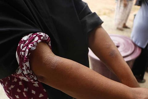 अध्ययन के अनुसार, 81 प्रतिशत प्रभावित देशों में गर्मी से होने वाली घमौरियों और त्वचा के चकत्तों में वृद्धि हुई।