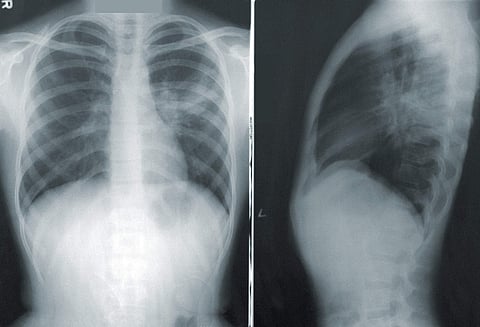 Detecting COVID through chest X-rays