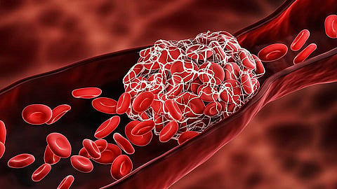blodd clots
