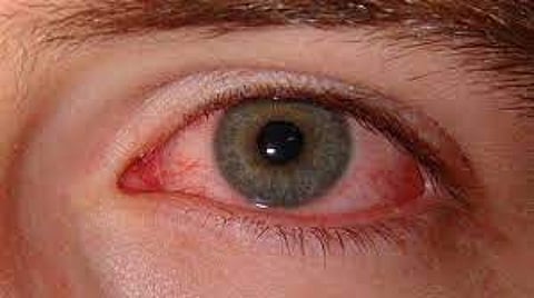 Mucormycosis