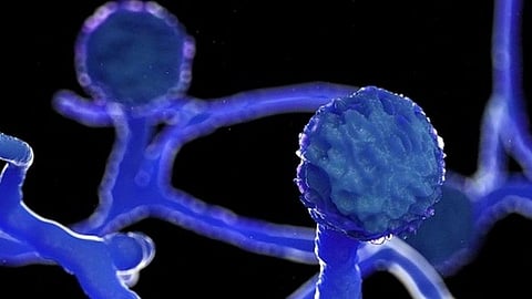 mucormycosis