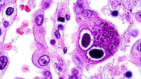 cytomegalovirus