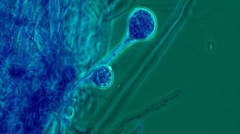 Mucormycosis