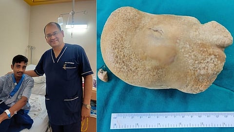 मूत्राशयातून काढला नारळाच्या आकाराचा मूतखडा, मुंबईत झाली शस्त्रक्रिया