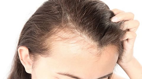 Hair Loss I Hair Gain Tips
