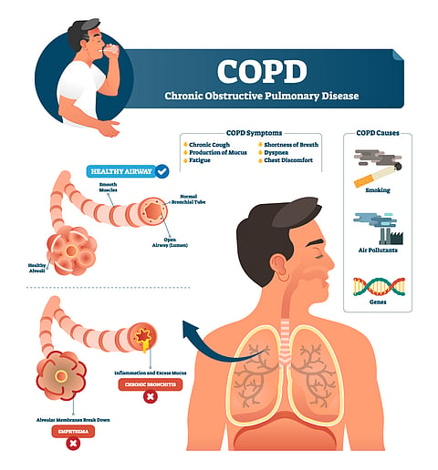 COPD Decease