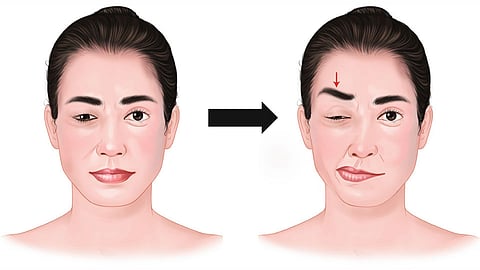 hemifacial spasm