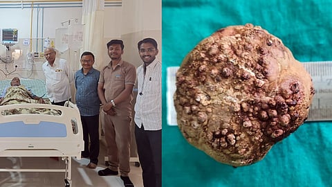 Patient with doctors & kidney stone