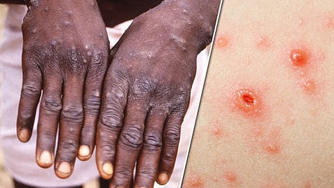 nearly 200 cases of monkeypox in more than 20 countries says who