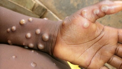 MonkeyPox