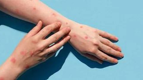 monkeypox