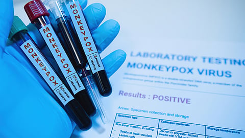 monkeypox suspected patient death