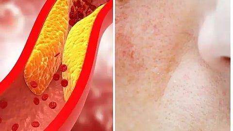 cholesterol