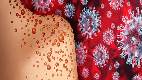 Monkeypox, Corona Latest News