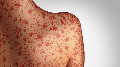 Measles Infection