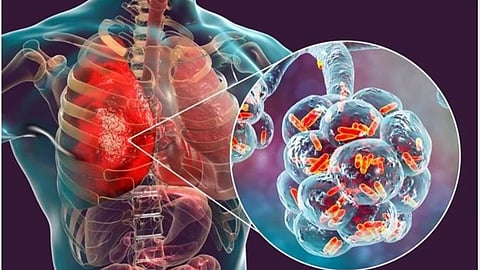 Pneumonia Disease