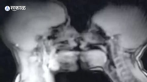 MRI