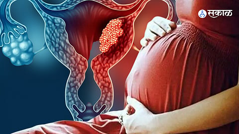Cervical cancer
