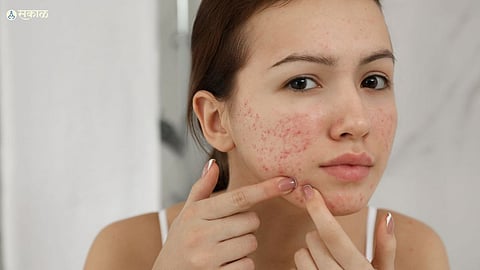 Pimples Problem