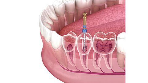 root canal