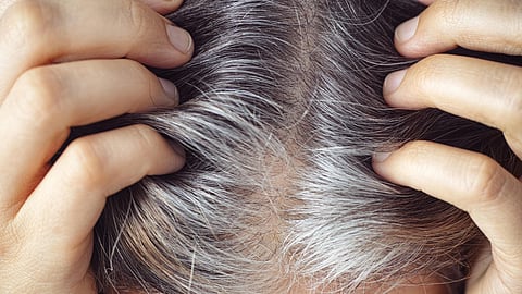 white hair causes young age