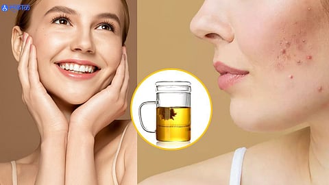 Anti Pimple Drinks