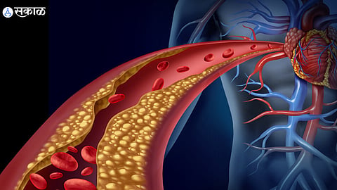Bad Cholesterol Control