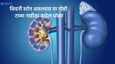 Kidney Stone