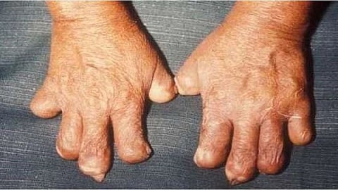 disease maharashtra country thousand patients increased diagnosis