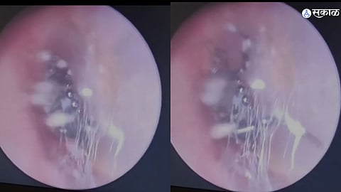 Spider in Womans ear
