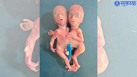 underdeveloped twins