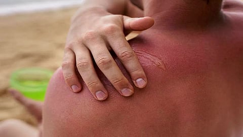Camphor Benefits for skin