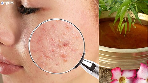Pimple Remedy
