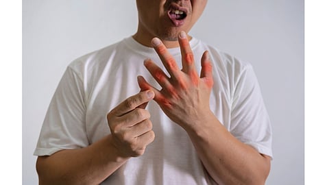 Uric acid and bone disease