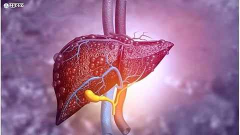 Liver Cirrhosis