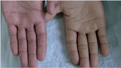 Anemia