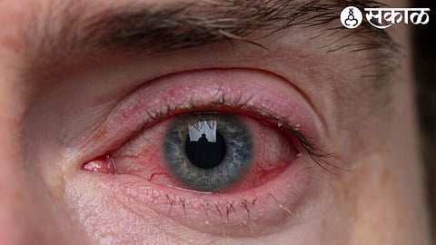Eyes Infection