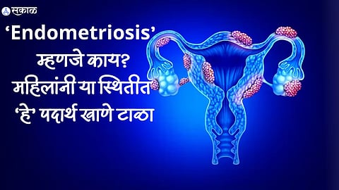 Endometriosis