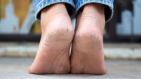 Cracked Heels