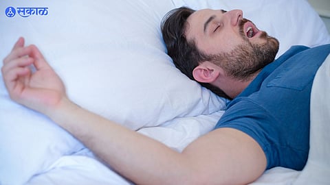 obstructive sleep apnea
