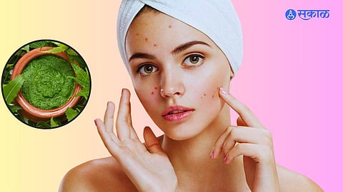 Home Remedies for Pimples