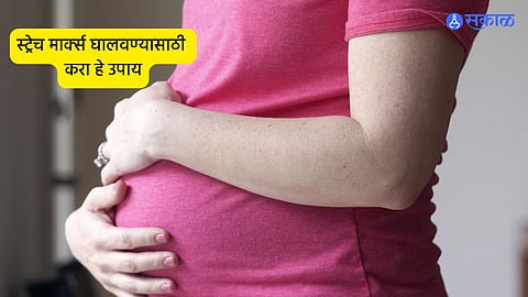 Home Remedies For Stretch Marks