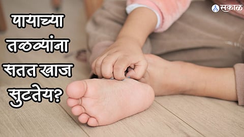 Home Remedies: पायाच्या तळव्यांना सतत खाज सुटतेय? मग या' घरगुती उपायांचा वापर करा