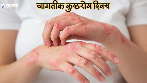 World Leprosy Day 2024 : कुष्ठरोग म्हणजे काय आणि कसा पसरतो हा रोग? जाणून घ्या त्याची लक्षणे, उपचार