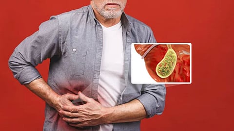 Gallstones Symptoms