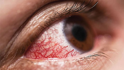 Red Eye