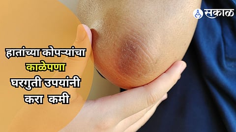 Home Remedies For Elbow